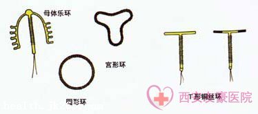 节育环的种类图片及节育环的选择