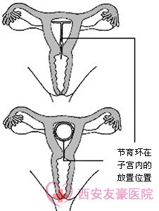 节育环的种类图片及节育环的选择